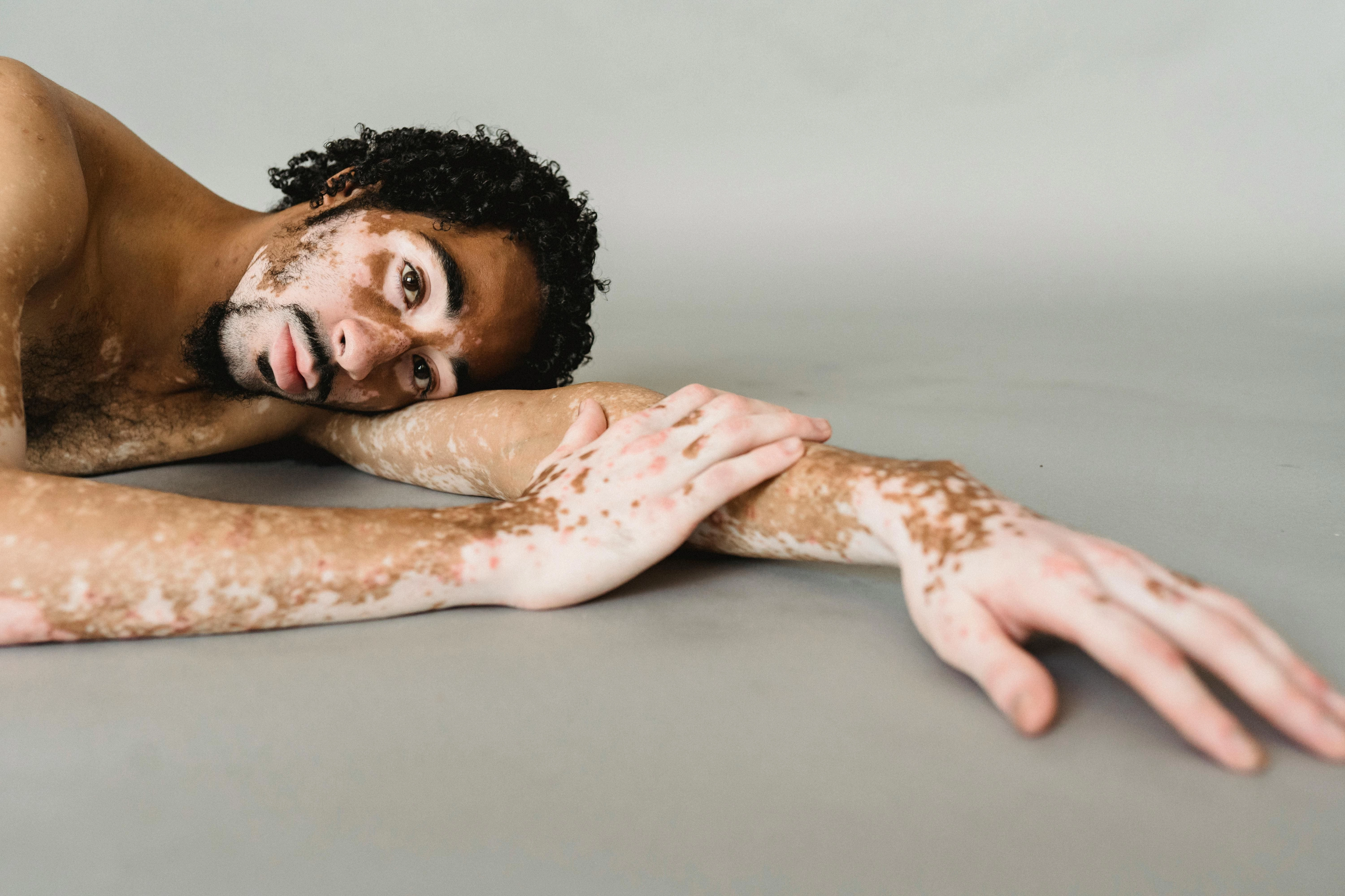 Vitiligo Treatment