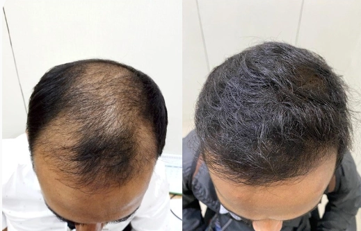 Hair Transplant