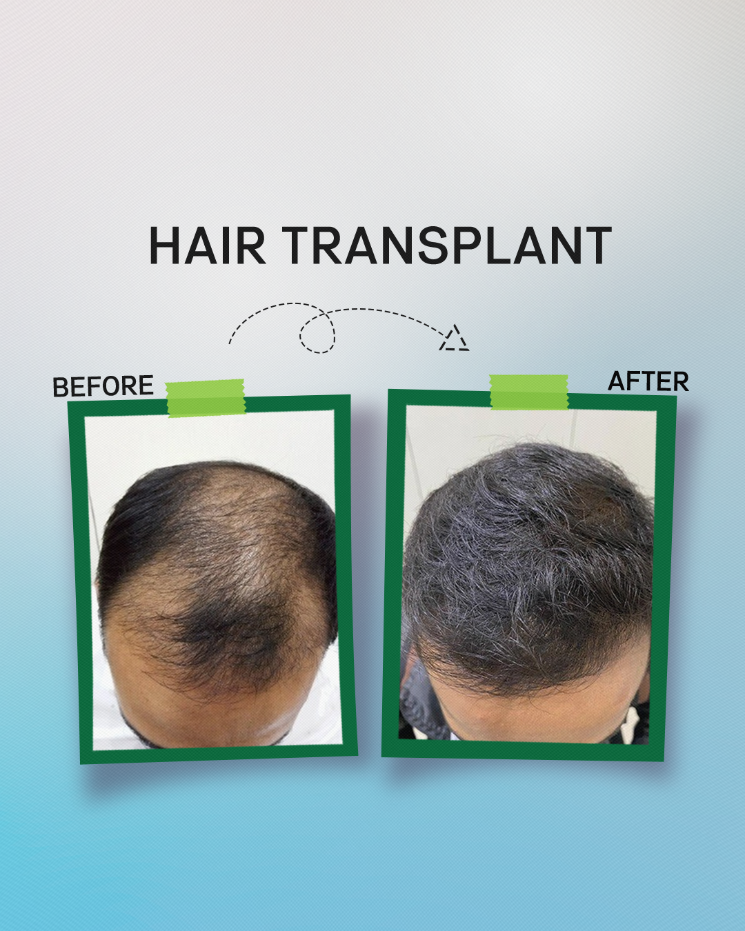Hair Transplant